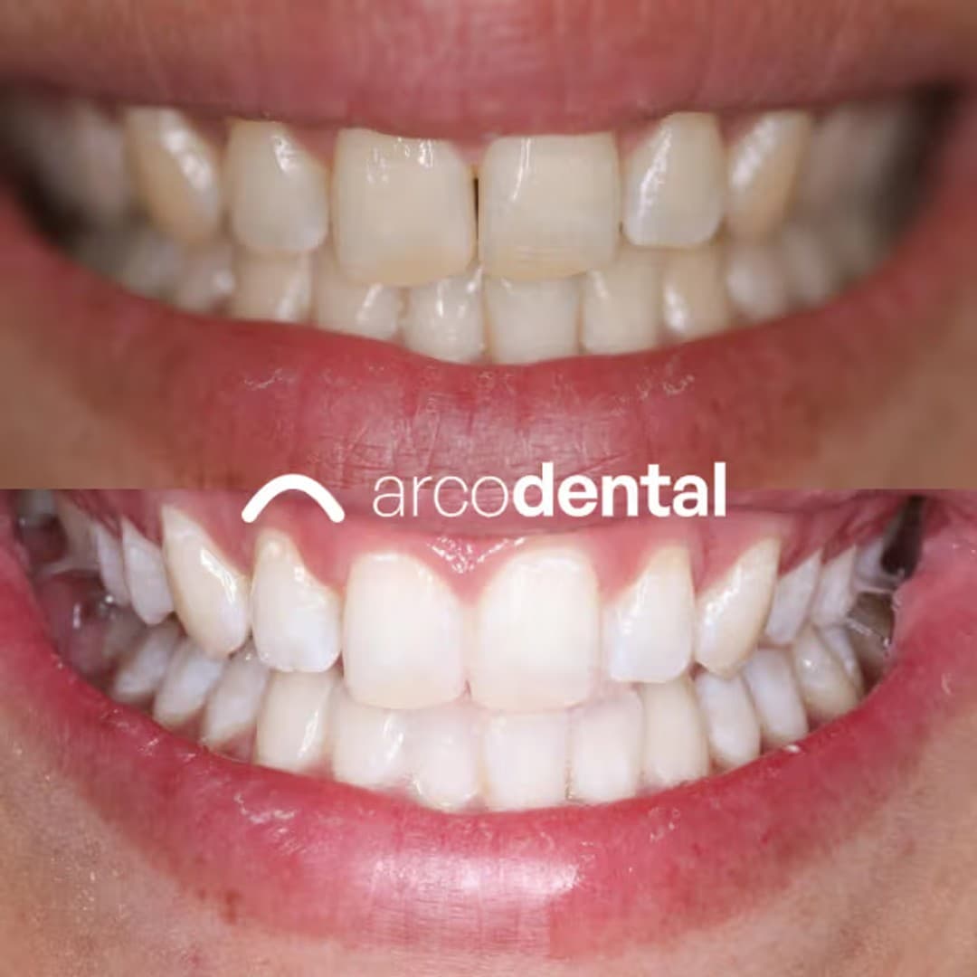 Blanqueamiento dental