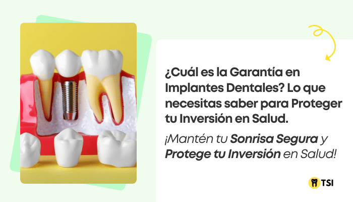 cual es la garantia en implantes dentales lo que necesitas saber 2