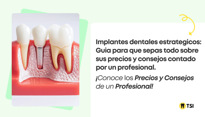 implantes dentales estrategicos guia 2