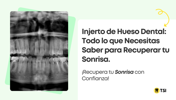 injerto de hueso dental todo lo que necesitas saber para recuperar tu sonrisa 2