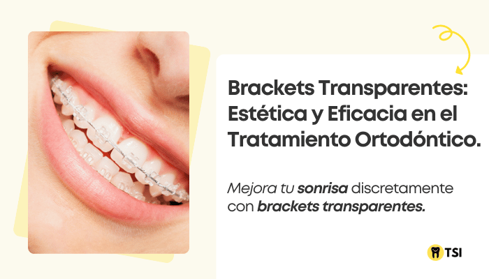 brackets transparentes estetica y eficacia en el tratamiento ortodontico 1
