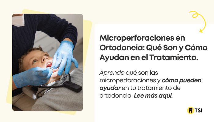 Microperforaciones en ortodoncia: acelera tu tratamiento de ortodoncia y alveolar