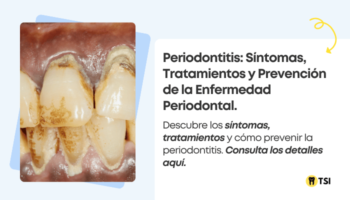 periodontitis sintomas tratamientos y prevencion de la enfermedad periodontal 1