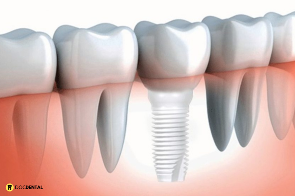 Implantes