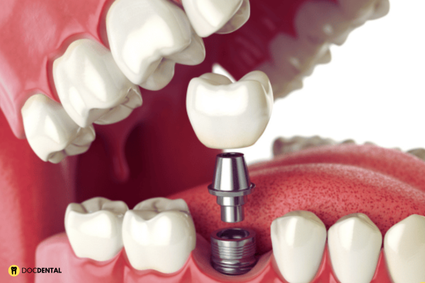 Implantes 2